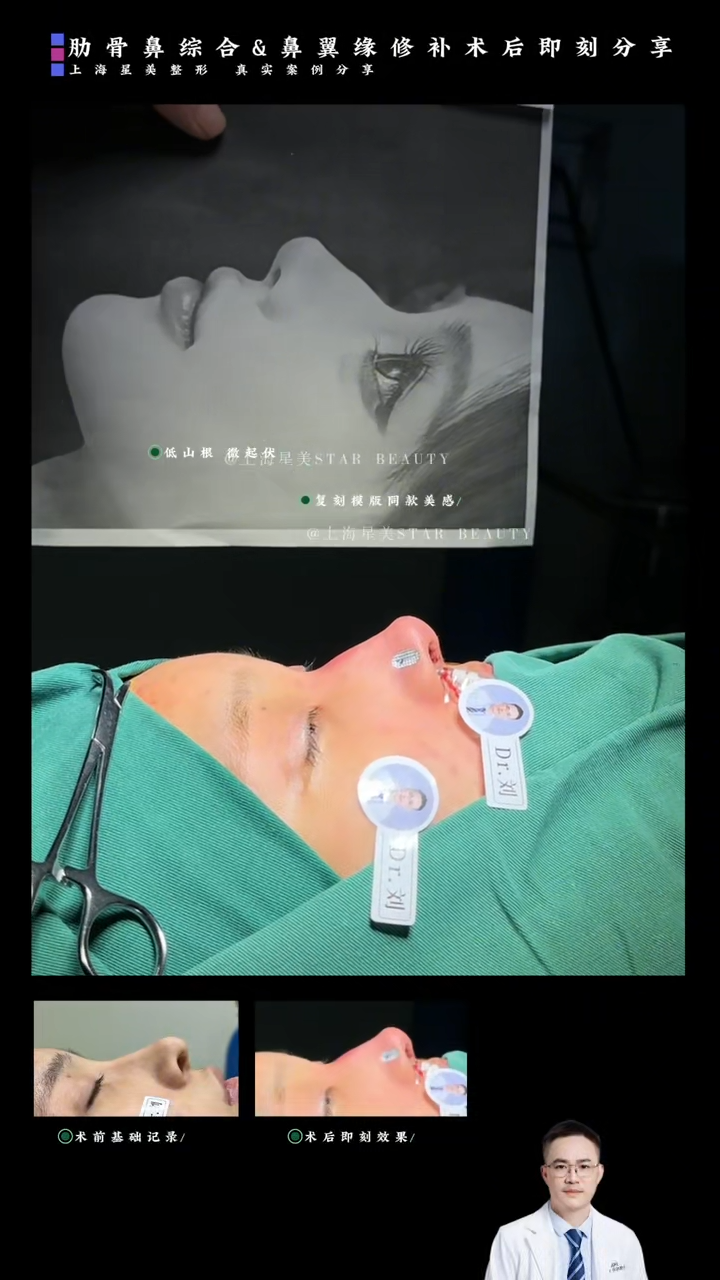 Kes Segera Selepas Pembedahan Sindrom Hidung Rib + Pembedahan Hidung Flanges: Satu Program Gabungan "Sokong Tip Hidung + Pengurangan Hidung Flanges"