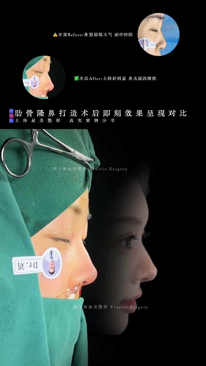 Pembedahan tulang rusuk menunjukkan kesan segera selepas pembedahan hidung