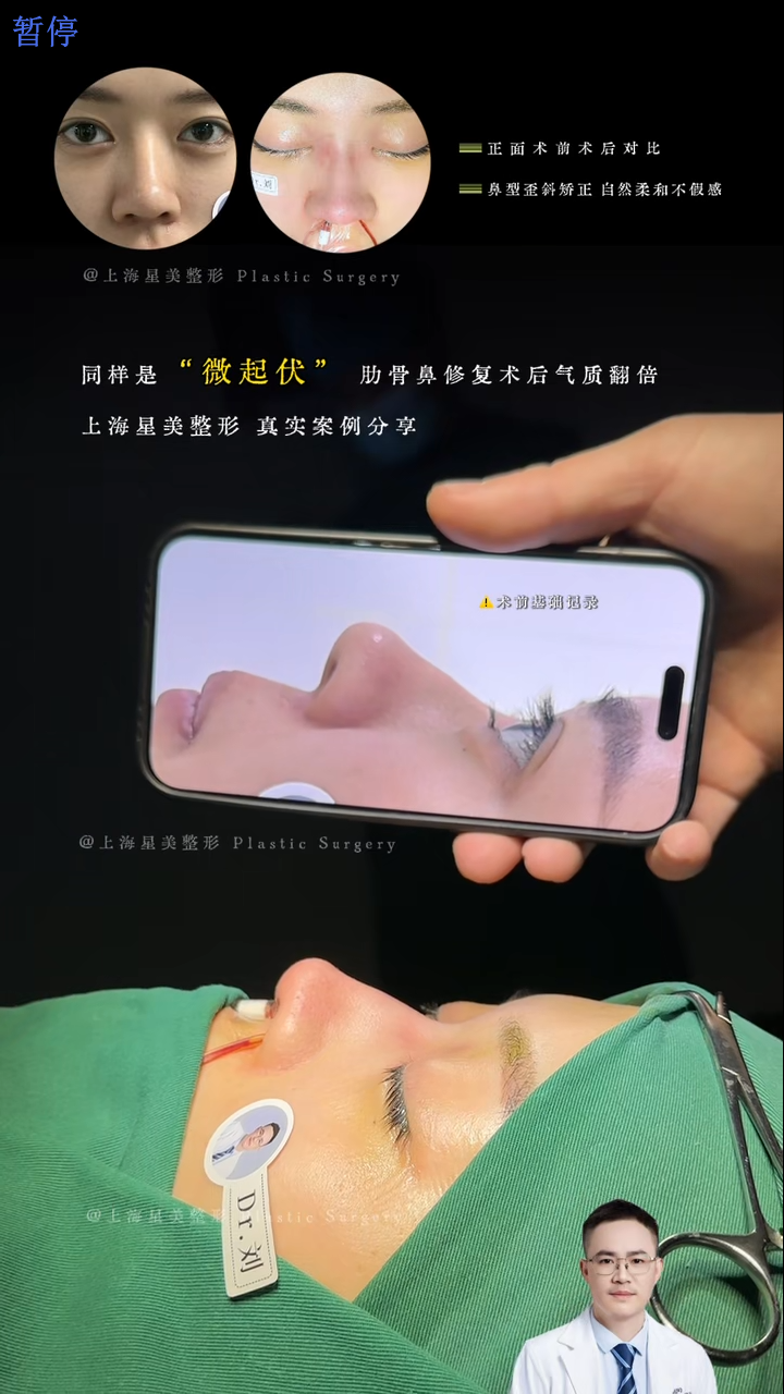 Perbaikan Hidung Rambut Mikro