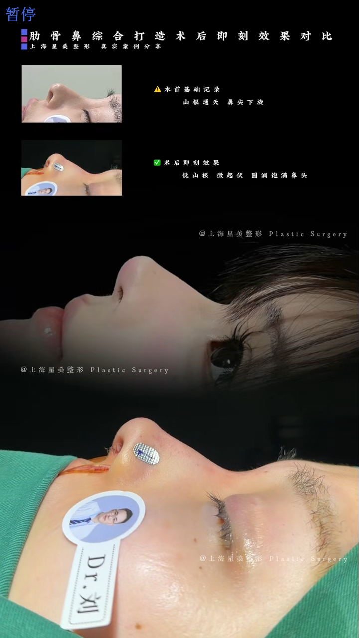 Membandingkan Sindrom Hidung Rib Segera Selepas Pembedahan